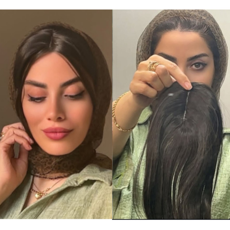 پروتز جلوسری فرقدار
